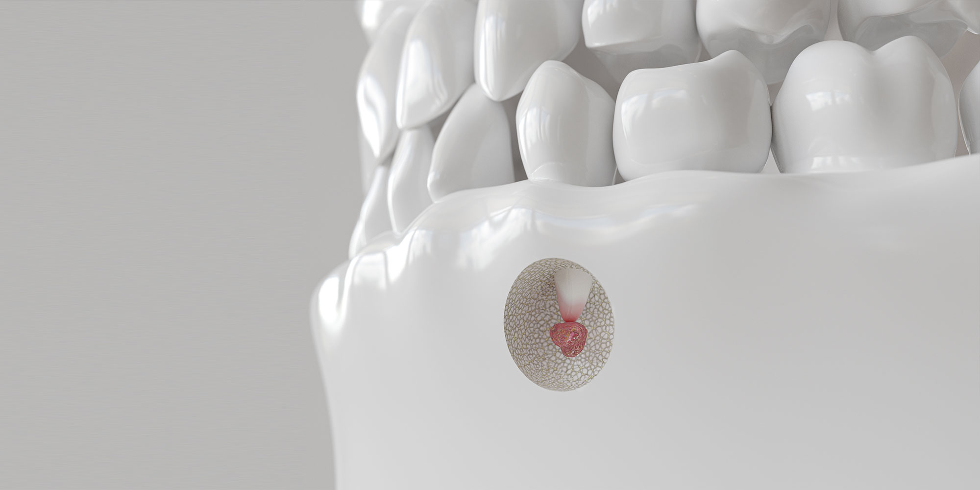 Root tip inflammation with apicectomy - 3D rendering