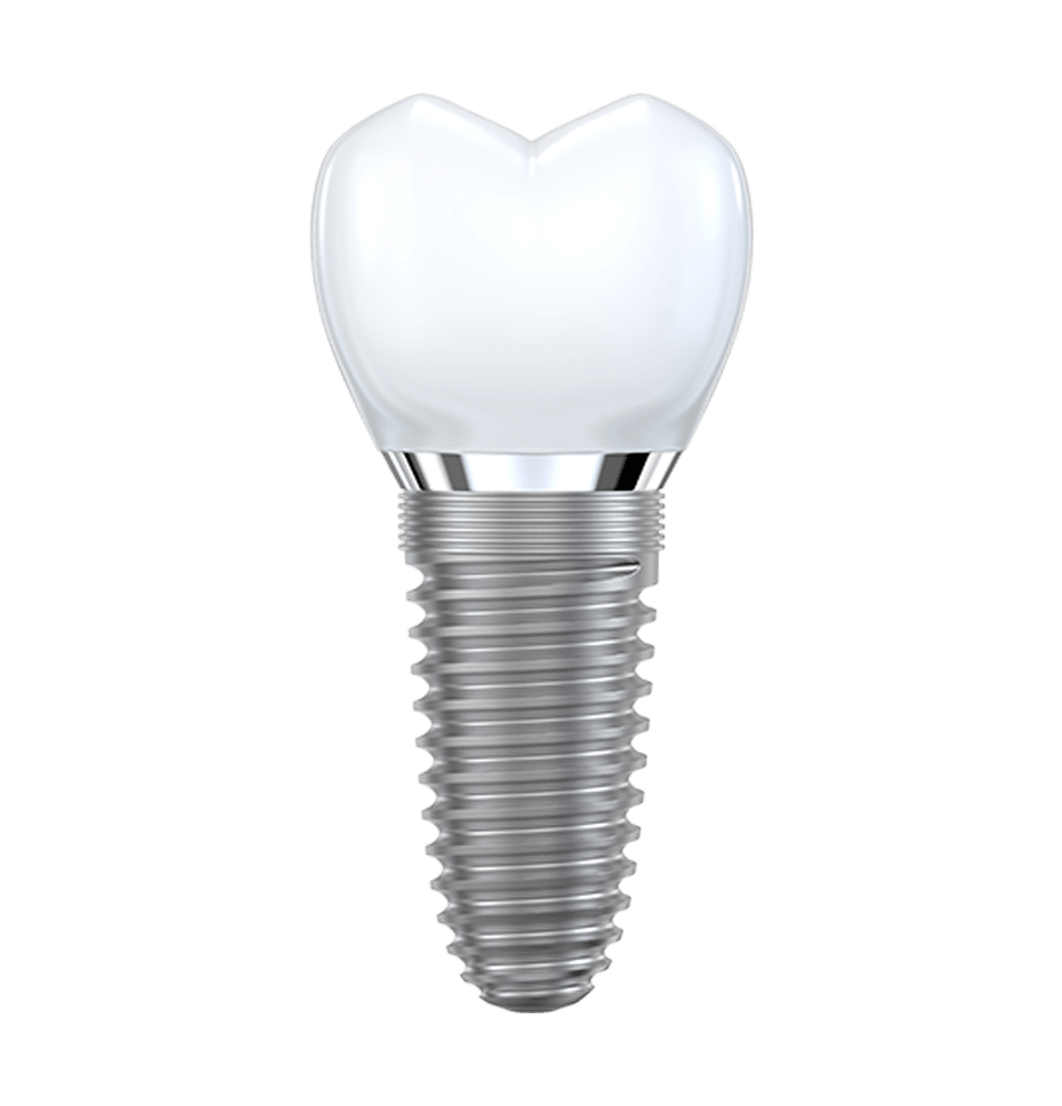 single dental implant