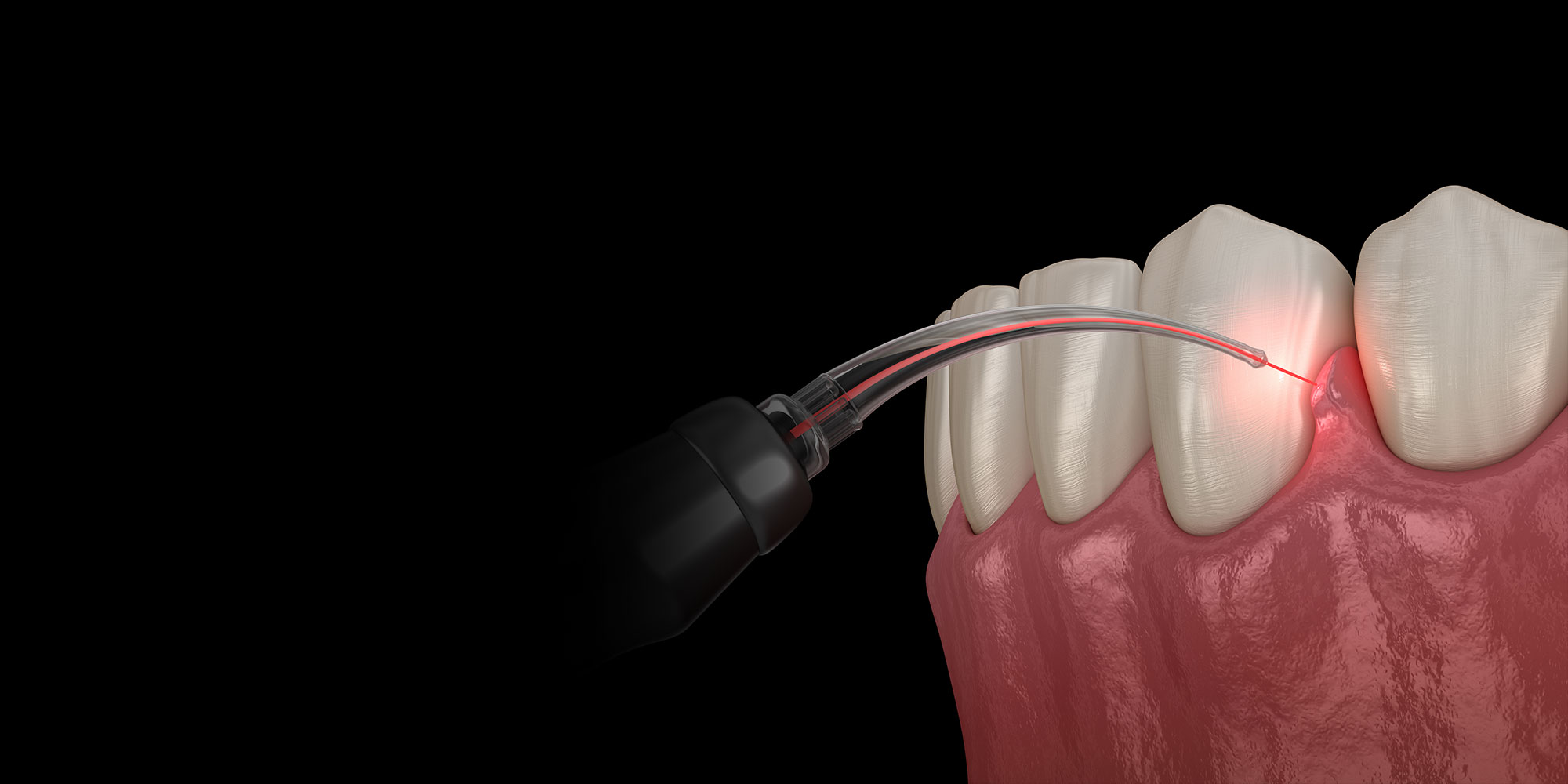 laser dentistry illustration