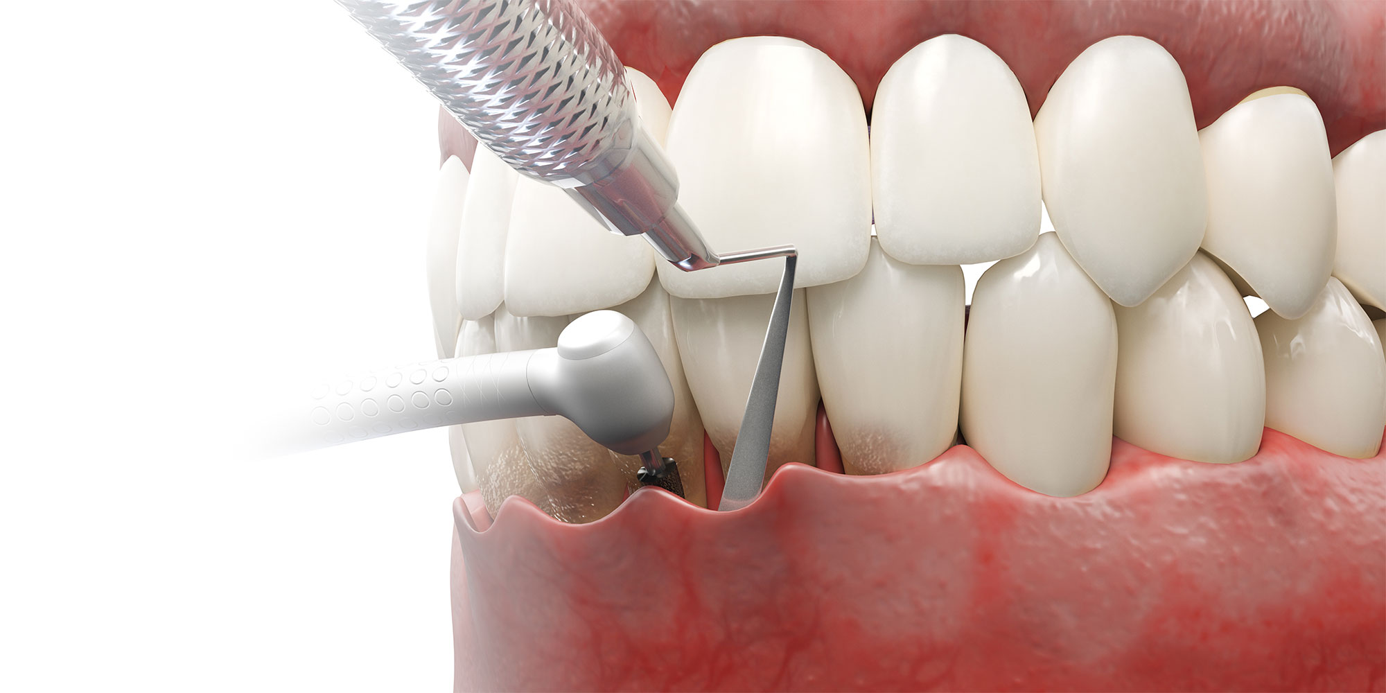 3d rendered illustration of dental pocket reduction