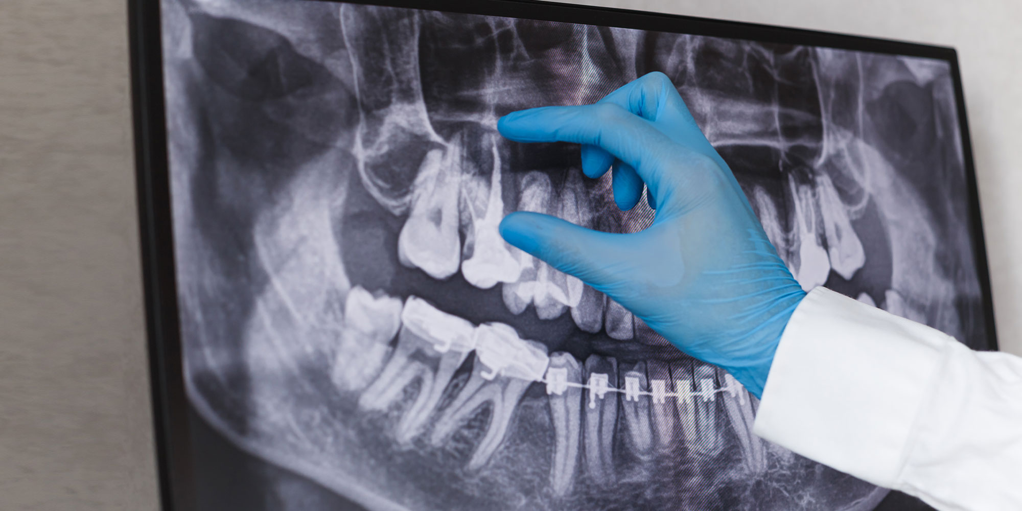 Doctor points to filled root canal in dental x-ray